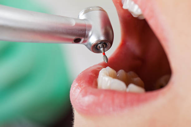 Best Emergency Wisdom Teeth Removal in Romney, WV